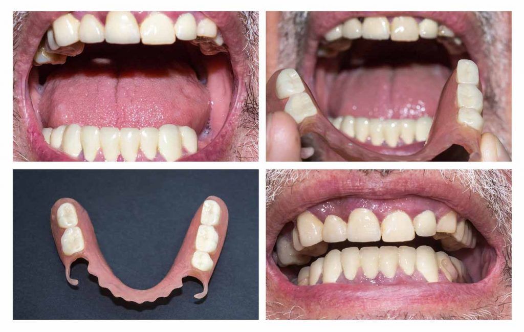 ▷【 Pastillas para limpiar Prótesis dentales y luce sonrisa 2024】✔️◁