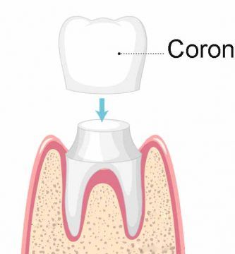 Protesis dental fija sin implantes