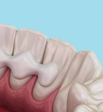 puente de maryland dental