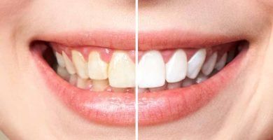 Que es la fluorosis dental