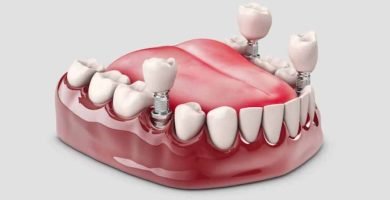 protesis dental fija sobreimplantes