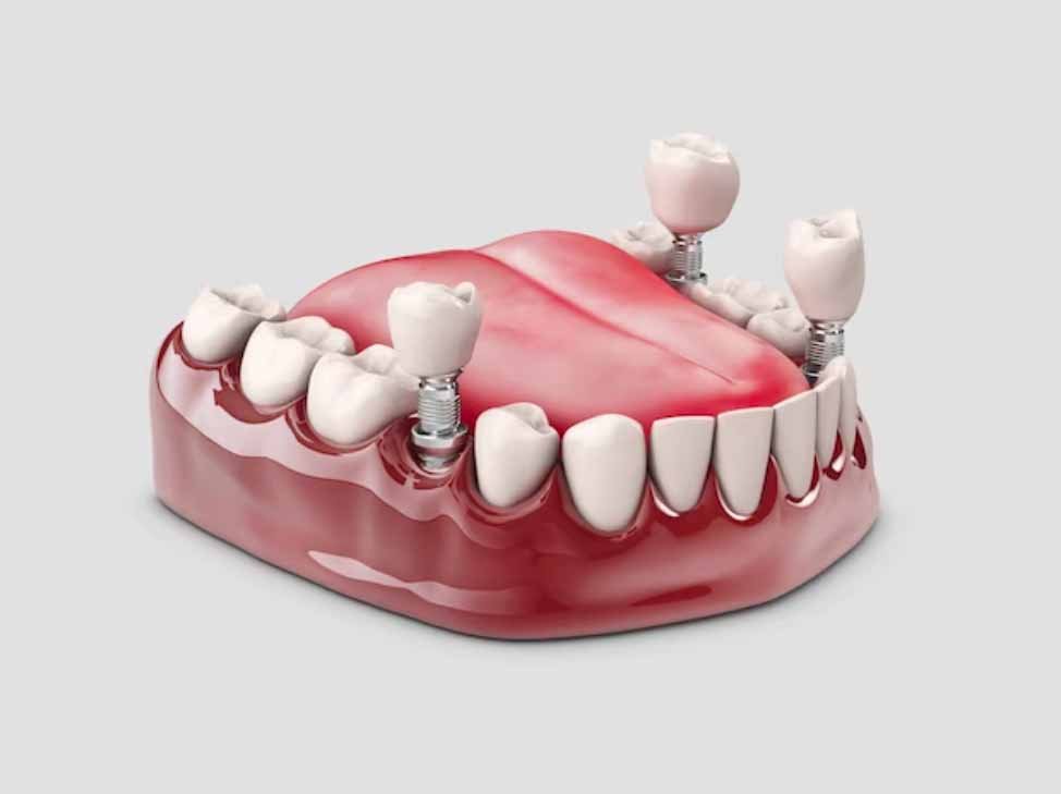 ▷【 Pegamento para prótesis dental 2024】✔️◁