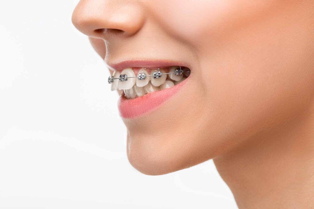 brackets autoligables