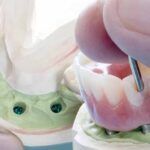 implantes dentales sin hueso