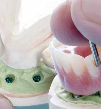 implantes dentales sin hueso