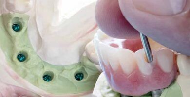 implantes dentales sin hueso