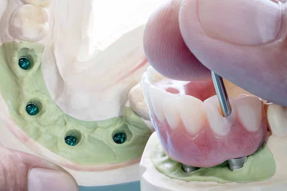 implantes dentales sin hueso